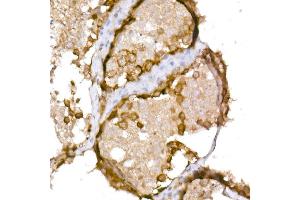 Immunohistochemistry of paraffin-embedded human testis using NY-ESO-1 Rabbit pAb (ABIN6129965, ABIN6139172, ABIN6139173 and ABIN6225112) at dilution of 1:150 (40x lens). (CTAG1B anticorps  (AA 1-180))