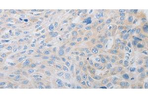 Immunohistochemistry of paraffin-embedded Human esophagus cancer using PDX1 Polyclonal Antibody at dilution of 1:30 (PDX1 anticorps)