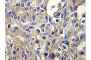 Immunohistochemical analysis of paraffin-embedded human liver carcinoma tissue using MELK polyclonal antibody . (MELK anticorps)