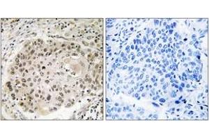 Immunohistochemistry analysis of paraffin-embedded human lung carcinoma, using USP36 Antibody. (USP36 anticorps  (AA 501-550))