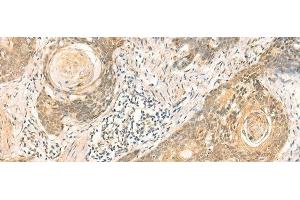 Immunohistochemistry of paraffin-embedded Human esophagus cancer tissue using NIP7 Polyclonal Antibody at dilution of 1:50(x200) (NIP7 anticorps)