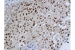 Formalin-fixed and paraffin embedded bladder cancer labeled with Anti-MCM-2 Polyclonal Antibody, Unconjugated (ABIN676238) at 1:200 followed by conjugation to the secondary antibody and DAB staining (MCM2 anticorps  (AA 601-700))