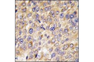 Formalin-Fixed, Paraffin-Embedded human hepatocarcinoma tissue reacted with Autophagy GABARAP Antibody (N-term) followed which was peroxidase-conjugated to the secondary antibody, followed by DAB staining. (GABARAP anticorps  (N-Term))