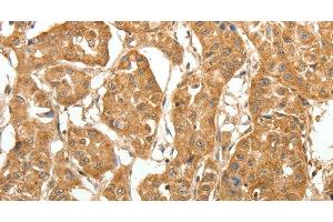 Immunohistochemistry of paraffin-embedded Human lung cancer tissue using MAP1B Polyclonal Antibody at dilution 1:60 (MAP1B anticorps)