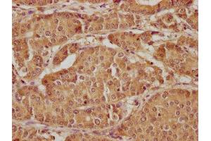 IHC image of ABIN7157400 diluted at 1:300 and staining in paraffin-embedded human gastric cancer performed on a Leica BondTM system.