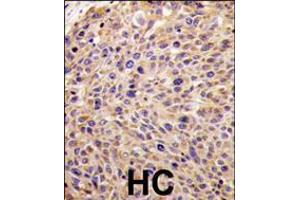 Formalin-fixed and paraffin-embedded human hepatocarcinoma tissue reacted with GGPS1 Antibody (N-term), which was peroxidase-conjugated to the secondary antibody, followed by DAB staining.
