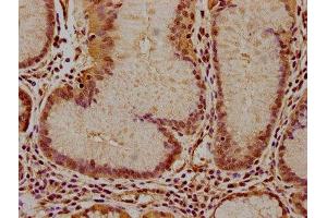 IHC image of ABIN7156557 diluted at 1:100 and staining in paraffin-embedded human gastric cancer performed on a Leica BondTM system. (IFNA16 anticorps  (AA 24-189))