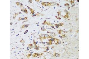 Immunohistochemistry of paraffin-embedded Human gastric cancer using ERLIN1 Polyclonal Antibody at dilution of 1:100 (40x lens). (ERLIN1 anticorps)