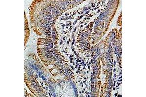 Immunohistochemical analysis of COX6B1 staining in human colon cancer formalin fixed paraffin embedded tissue section. (COX6B1 anticorps)