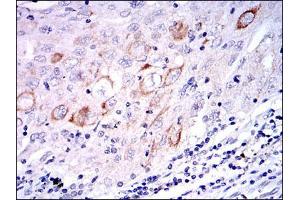 Immunohistochemical analysis of paraffin-embedded lung cancer tissues using MAP2K7 mouse mAb with DAB staining.