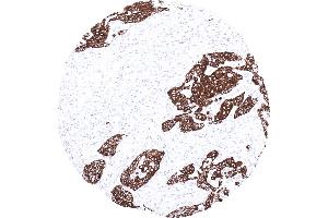 Strong cytokeratin 13 immunostaining in a squamous cell carcinoma of the oral cavity (Cytokeratin 13 anticorps)