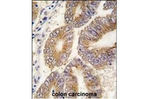 Formalin-fixed and paraffin-embedded human colon carcinoma tissue reacted with AHCY antibody (C-term) (ABIN389202 and ABIN2839362) , which was peroxidase-conjugated to the secondary antibody, followed by DAB staining.