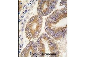 Formalin-fixed and paraffin-embedded human colon carcinoma tissue reacted with AHCY antibody (C-term) (ABIN389202 and ABIN2839362) , which was peroxidase-conjugated to the secondary antibody, followed by DAB staining. (AHCY anticorps  (C-Term))