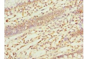 Immunohistochemistry of paraffin-embedded human colon cancer using ABIN7162554 at dilution of 1:100 (ZDHHC5 anticorps  (AA 231-500))
