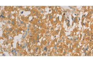 Immunohistochemistry of paraffin-embedded Human thyroid cancer tissue using PRPSAP1 Polyclonal Antibody at dilution 1:80 (PRPSAP1 anticorps)