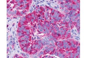 Anti-GPR137B antibody IHC of human Ovary, Carcinoma. (GPR137B anticorps  (C-Term))