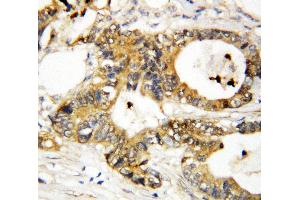 Anti-Annexin A3 antibody, IHC(P) IHC(P): Human Mammary Cancer Tissue