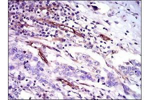 Immunohistochemical analysis of paraffin-embedded esophageal cancer tissues using CD59 mouse mAb with DAB staining.