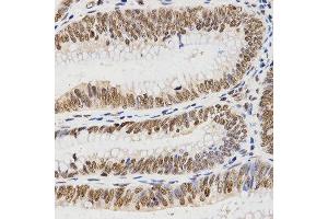 Immunohistochemistry of paraffin-embedded human rectal cancer tissue using Histone H3 antibody at dilution of 1:200 (x400 lens). (Histone 3 anticorps  (C-Term))