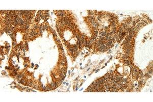 Immunohistochemistry of paraffin-embedded Human colon cancer using COX7B Polyclonal Antibody at dilution of 1:60 (COX7B anticorps)