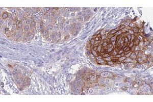 ABIN6279126 at 1/100 staining Human urothelial cancer tissue by IHC-P. (SLC4A2 anticorps  (Internal Region))