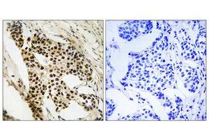 Immunohistochemistry analysis of paraffin-embedded human breast carcinoma tissue, using MAPKAPK2 (epitope around residue 272) antibody.