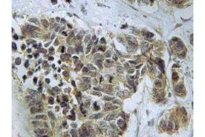 Immunohistochemistry analyzes of Caspase 9 antibody in paraffin-embedded human lung carcinoma tissue. (Caspase 9 anticorps)