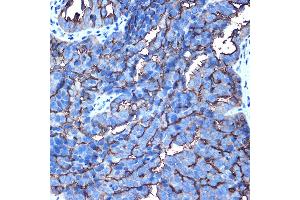 Immunohistochemistry of paraffin-embedded human oophoroma using MUC1 Rabbit pAb (ABIN6131522, ABIN6144194, ABIN6144195 and ABIN6213810) at dilution of 1:100 (40x lens).
