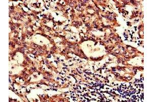 Immunohistochemistry of paraffin-embedded human lung cancer using ABIN7160929 at dilution of 1:100 (NDUFB6 anticorps  (AA 2-67))