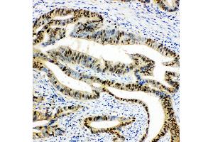 Anti-DUT antibody,  IHC(P) IHC(P): Human Intestinal Cancer Tissue