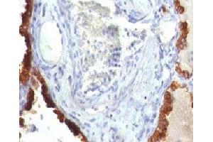 Formalin-fixed, paraffin-embedded human lung carcinoma stained with Cytokeratin 7 antibody (KRT7/760) (Cytokeratin 7 anticorps)