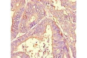 Immunohistochemistry of paraffin-embedded human endometrial cancer using ABIN7143790 at dilution of 1:100 (alpha 2 Macroglobulin anticorps  (AA 1216-1467))