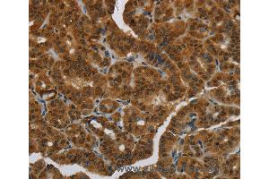 Immunohistochemistry of Human breast cancer using MRE11A Polyclonal Antibody at dilution of 1:60 (Mre11 anticorps)
