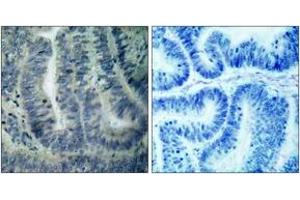 Immunohistochemistry analysis of paraffin-embedded human colon carcinoma tissue, using BAD (Ab-112) Antibody. (BAD anticorps  (AA 78-127))