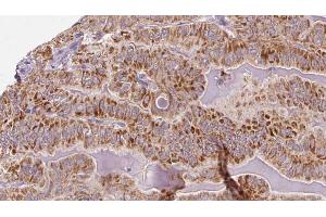ABIN6273318 at 1/100 staining Human thyroid cancer tissue by IHC-P. (SHMT1 anticorps  (Internal Region))