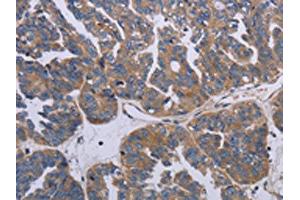The image on the left is immunohistochemistry of paraffin-embedded Human ovarian cancer tissue using ABIN7191790(PARP4 Antibody) at dilution 1/20, on the right is treated with synthetic peptide. (PARP4 anticorps)