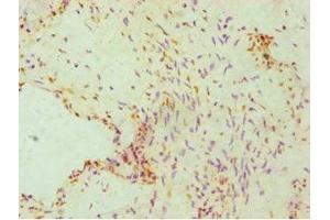 Immunohistochemistry of paraffin-embedded human cervical cancer using ABIN7162842 at dilution of 1:100
