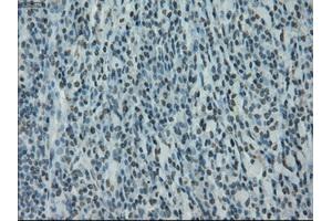 Immunohistochemical staining of paraffin-embedded Carcinoma of bladder tissue using anti-PRKYmouse monoclonal antibody. (PRKY anticorps)