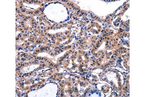 Immunohistochemistry of Human thyroid cancer using FBN1 Polyclonal Antibody at dilution of 1:47 (Fibrillin 1 anticorps)