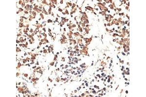 Immunohistochemistry of paraffin-embedded Human lung cancer using MCM5 Polyclonal Antibody at dilution of 1:100 (40x lens).