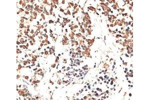 Immunohistochemistry of paraffin-embedded Human lung cancer using MCM5 Polyclonal Antibody at dilution of 1:100 (40x lens). (MCM5 anticorps)