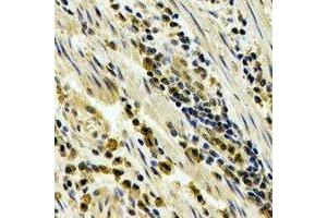 Immunohistochemical analysis of STAU1 staining in human esophageal cancer formalin fixed paraffin embedded tissue section.
