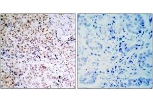 Immunohistochemistry analysis of paraffin-embedded human breast carcinoma, using Retinoblastoma (Phospho-Ser795) Antibody. (Retinoblastoma Protein (Rb) anticorps  (pSer795))