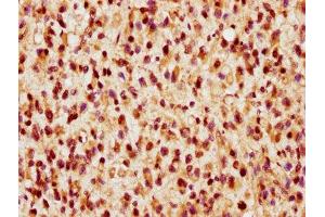 IHC image of ABIN7172411 diluted at 1:300 and staining in paraffin-embedded human glioma performed on a Leica BondTM system.