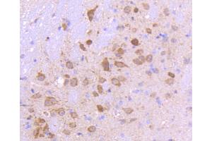 Paraformaldehyde-fixed, paraffin embedded human lung cancer, Antigen retrieval by boiling in sodium citrate buffer (pH6) for 15min, Block endogenous peroxidase by 3% hydrogen peroxide for 30 minutes, Blocking buffer at 37°C for 20min, Antibody incubation with Smad3 (3D1) Monoclonal Antibody  at 1:50 overnight at 4°C, followed by a conjugated secondary and DAB staining.