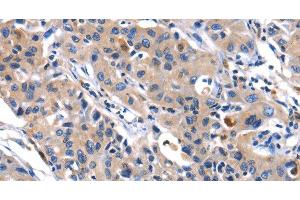 Immunohistochemistry of paraffin-embedded Human lung cancer tissue using MMP16 Polyclonal Antibody at dilution 1:40 (MMP16 anticorps)
