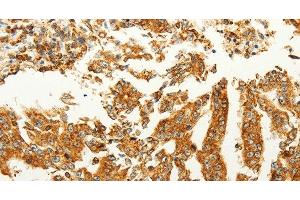 Immunohistochemistry of paraffin-embedded Human gastric cancer tissue using FZD6 Polyclonal Antibody at dilution 1:60 (FZD6 anticorps)
