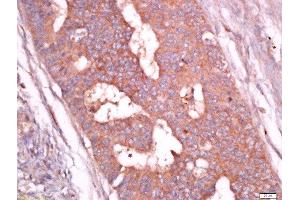 paraformaldehyde-fixed, paraffin embedded human colon carcinoma tissue, Antigen retrieval by boiling in sodium citrate buffer(pH6) for 15min, Block endogenous peroxidase by 3% hydrogen peroxide for 30 minutes, Blocking buffer (normal goat serum) at 37°C for 20min, Antibody incubation with Rabbit Anti-Troponin T Polyclonal Antibody, Unconjugated  at 1:400 overnight at 4°C, followed by a conjugated secondary and DAB staining (Troponin T anticorps  (AA 201-298))