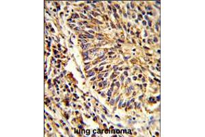 Formalin-fixed and paraffin-embedded human lung carcinoma reacted with ADAM9 Antibody , which was peroxidase-conjugated to the secondary antibody, followed by DAB staining.