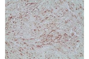 Immunohistochemistry analysis of human melanoma skin tissue using Melanoma marker (human) mAb (HMB45) (Ready-To-Use), (ABIN7211671). (Melanoma Marker anticorps)
